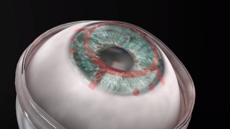 An artificial cornea helped a blind man regain his sight